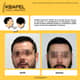 Slider image (8) Kbapel Hair Transplant